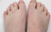 Сросшиеся указательный и средний пальцы на ногах. Синдактилия пальцев. Когда происходит операция